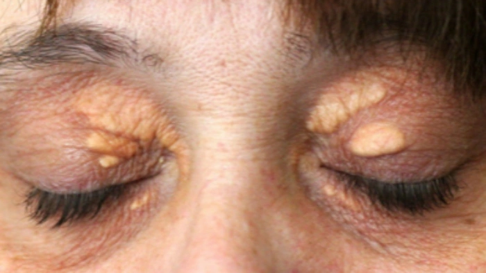 xantelasma-392x262-px